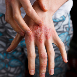 الأكزيما أو التهاب الجلد التأتبي (Atopic Dermatitis