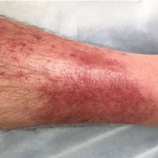 التهاب الهلل (Cellulitis)