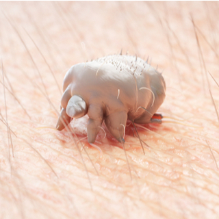 الجرب (Scabies)