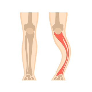 عوامل الخطر: بعض أمراض العظام.