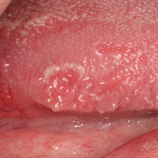 أعراض سرطان اللسان الفموي أعراض سرطان اللسان الفموي