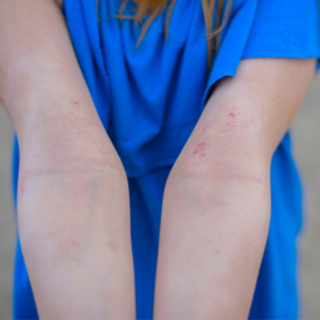 أكزيما التهاب الجلد التماسي