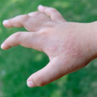 أكزيما خلل التعرق