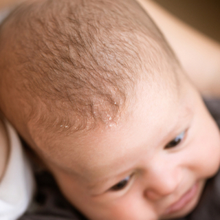 أكزيما التهاب الجلد الدهني