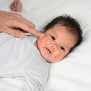 نصائح للتعامل مع الأكزيما عند الأطفال