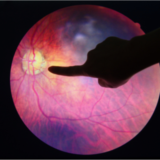 اعتلال الشبكية السكري