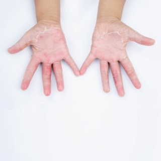 التهاب الجلد التماسي (Contact dermatitis)