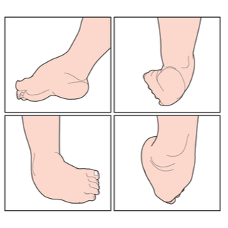 أعراض القدم الحنفاء أعراض القدم الحنفاء