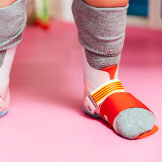 مضاعفات طفيفة للقدم الحنفاء مضاعفات طفيفة للقدم الحنفاء