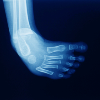 تشخيص القدم الحنفاء تشخيص القدم الحنفاء