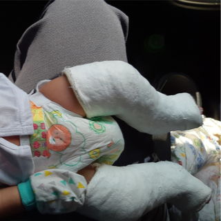 علاج القدم الحنفاء علاج القدم الحنفاء