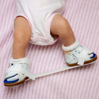 الدعامات الخاصة بمشكلة القدم الحنفاء الدعامات الخاصة بمشكلة القدم الحنفاء