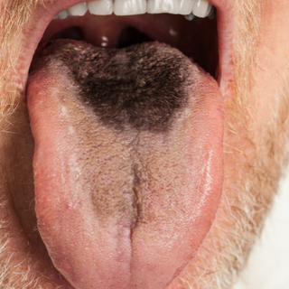 اللسان الأسود المشعر