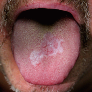 الحزاز المسطح الفموي