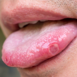 القروح الفموية