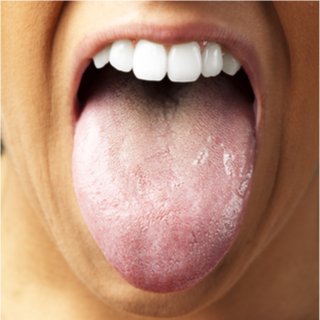 التغير في اللون (الوردي، الأبيض)