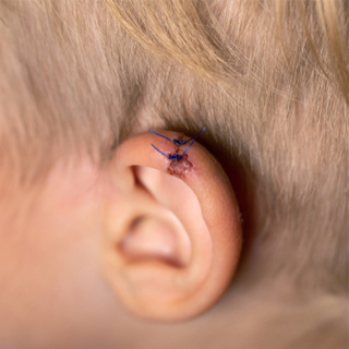 تكلس غضروف الأذن 