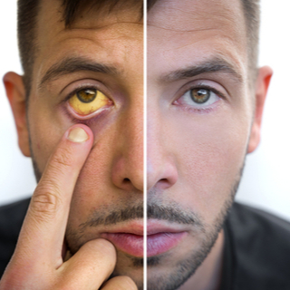 أعراض الإصابة بتليف الكبد