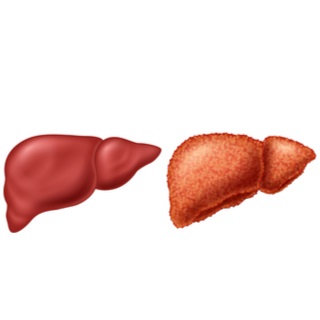 أسباب تليف الكبد