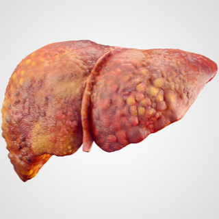 المرحلة الثانية من تليف الكبد