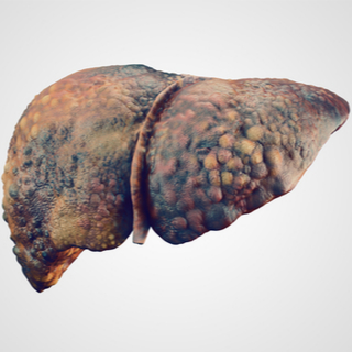 المرحلة الثالثة من تليف الكبد