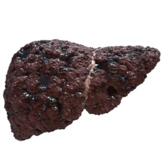 المرحلة الرابعة من تليف الكبد