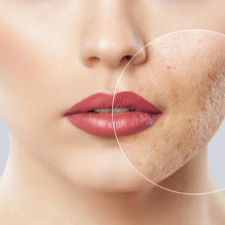 علاج حب الشباب بالصور