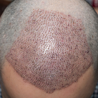 ما بعد الجراحة