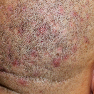 مخاطر عملية زراعة الشعر