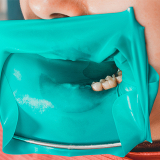 إزالة لب السن