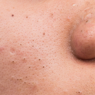 أسباب تكوّن الرؤوس السوداء