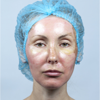 مرحلة ما بعد التقشير الكيميائي