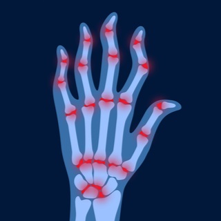 التهاب المفصل الروماتويدي وعشبة المرة