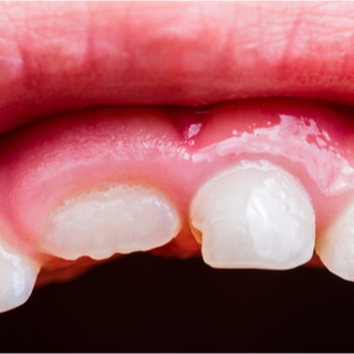 التهابات اللثة وعشبة المرة