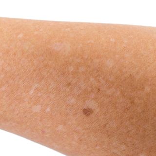 الفرق بين البقع البيضاء والبهاق من حيث الأعراض