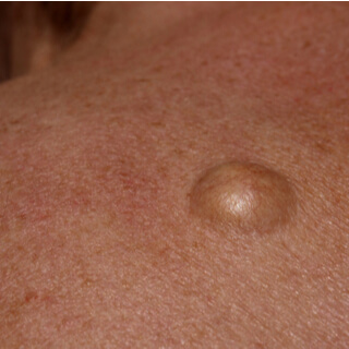 شكل الورم السرطاني تحت الإبط