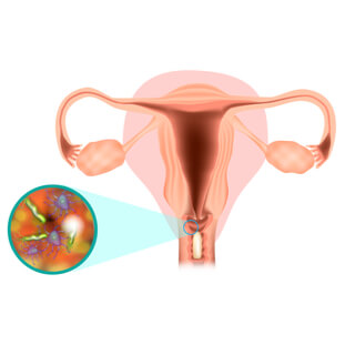 جفاف المهبل جفاف المهبل