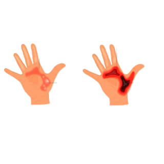 تحديد نوع الحرق