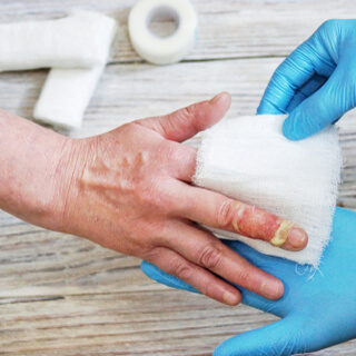 تغطية منطقة الحرق