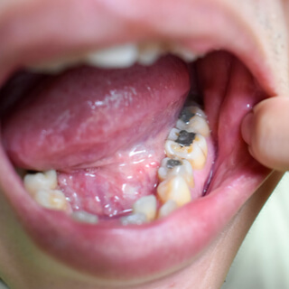 2. الحشو الفضة