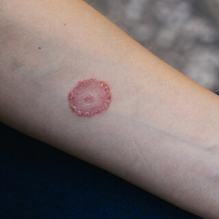 أنواع تينيا الجلد أنواع تينيا الجلد