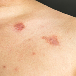 1. تينيا الجسم (Tinea corporis) 1. تينيا الجسم (Tinea corporis)
