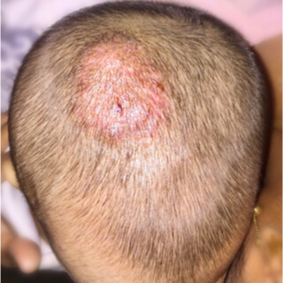 3. تينيا الرأس (Tinea capitis) 3. تينيا الرأس (Tinea capitis)