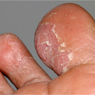 4. تينيا القدم (Tinea pedis) 4. تينيا القدم (Tinea pedis)