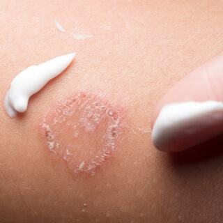 علاج تينيا الجلد علاج تينيا الجلد