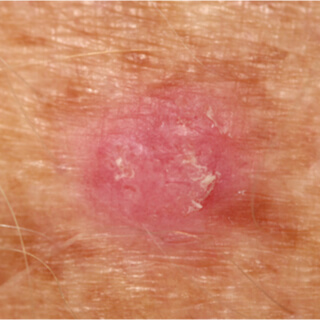 أعراض سرطان الجلد الحرشفي