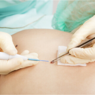 علاج سرطان الجلد الحرشفي