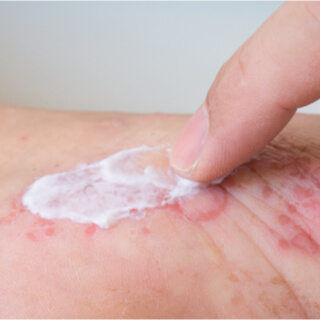 الستيرويدات الموضعية