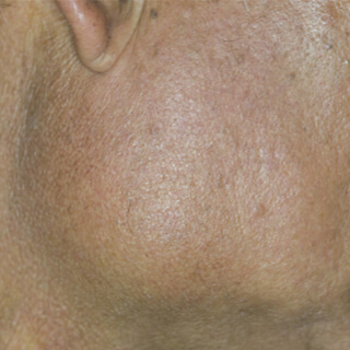 3. كتل على الفك