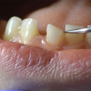 4. حركة الأسنان